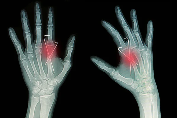 Film X-ray de fracture de la main : montrer fracture métacarpienne os rincer — Photo