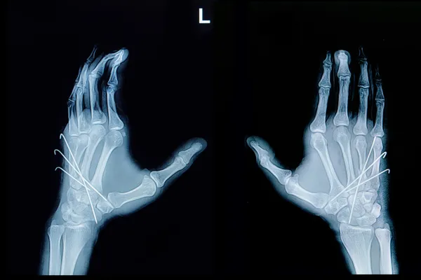 Film x-ray of hand fracture : show fracture metacarpal bone inse — Stock Photo, Image