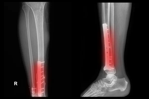 Röntgenkép a törés láb (tibia)-val implantátum lemez és a képernyő — Stock Fotó
