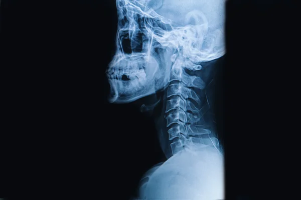Imaginea cu raze X a coloanei vertebrale cervicale, imaginea cu raze X a gâtului — Fotografie, imagine de stoc