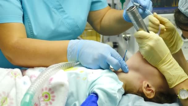 Intubación traqueal en paciente pediátrico en reanimación. Anestesiólogo médico inserta tubo endotraqueal antes de la operación quirúrgica. Procedimiento de intubación. Preparación para la anestesia general. 4 k vídeo — Vídeos de Stock