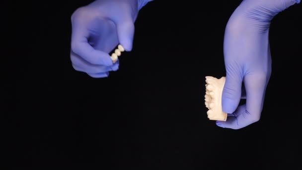 Concept dentaire sur fond noir. Modèle de dents et de pontage dentaire tenus par les mains dans des gants bleus. Images verticales. Prothèse partielle amovible, prothèse mandibulaire. Prosthodontie médicale — Video