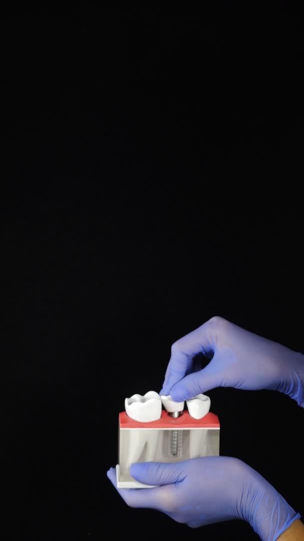 Dentalkonzept auf schwarzem Hintergrund. Modell von Zähnen und Überbrückungskrone, die von den Händen in blauen Handschuhen gehalten werden. Vertikale Aufnahmen. Herausnehmbare Teilprothese, Kieferprothese. Medizinisch — Stockvideo