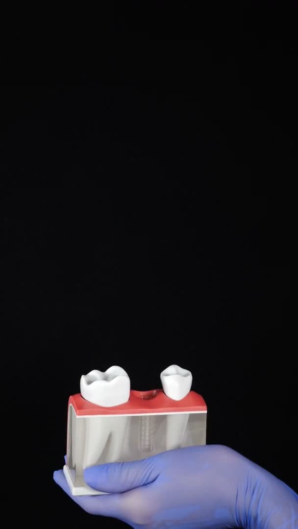 Η έννοια της προστασίας των δοντιών. Κάθετη λήψη σε μαύρο φόντο. Κάθετο βίντεο. Χέρι στο γάντι εισάγει τεχνητό δόντι στο μοντέλο σαγόνι. νέο δόντι εισάγεται στην οδοντοστοιχία. Διαδικασία εγκατάστασης δοντιού — Αρχείο Βίντεο