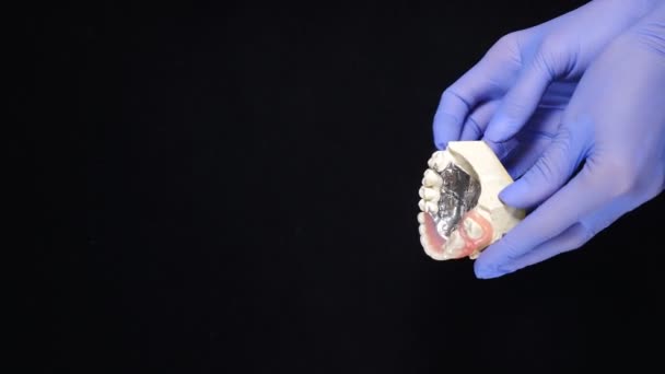 Dámské ruce v modrých rukavicích držící model čelisti se zubním přemostěním a vzorkem korunky. Černé pozadí. Zubní koncept. Vertikální záběry. Demonstrační model lidských zubů u zubního lékařství. Zuby — Stock video