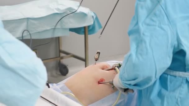 Chirurgie laparoscopique à l'hôpital. Matériel médical moderne dans la salle d'opération. Intervention chirurgicale dans la cavité abdominale pour le traitement ou l'élimination de la pathologie, mouvements précis et soigneux du médecin — Video