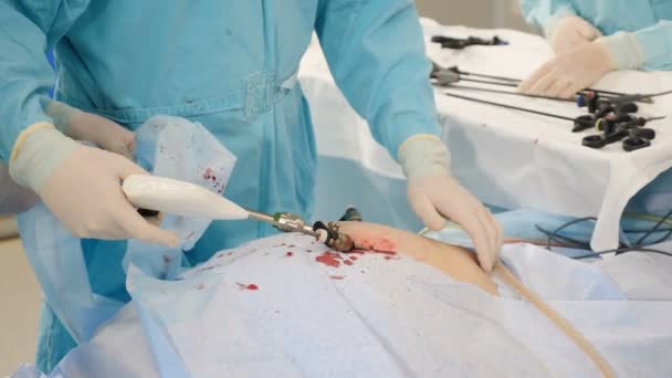 Hastanede laparoskopik ameliyat. Ameliyathanede modern tıbbi ekipman var. Patolojinin tedavisi ya da yok edilmesi için karın boşluğuna cerrahi müdahale, doktorun dikkatli hassas hareketleri — Stok video