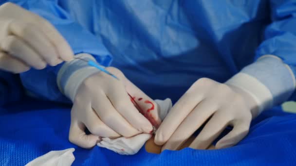현대의 클리닉 에서의 복강경 수술이요. 외과용 가운 과 최신 기술을 사용하여 정맥에 수술을 하는 장갑 전문 의사들 이다. 심장병. 심장 혈관 검사요. 수술 — 비디오