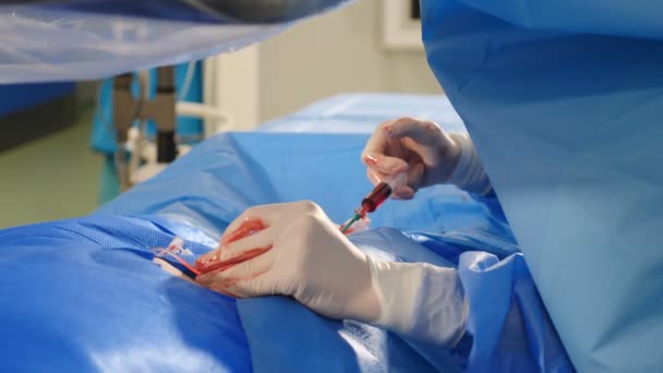 Vascular surgery in modern clinic. Professional doctors in surgical gowns and gloves carrying out operation on veins using latest technology. Heart disease. Cardio-vascular examination. operation — Stock Video