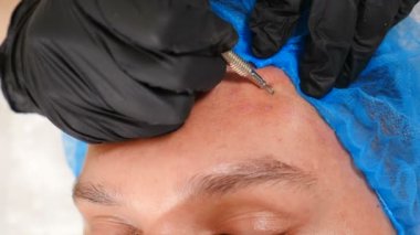 Cosmetology beauty clinic. Male patient getting facial treatment. Acne cleaning procedure with medical spoke tool. Beautician making face skin cleaning of man. Inflammation men treatment. 4 k video