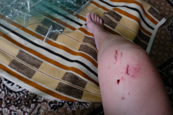 Раненая Женская Нога Фоне Разбитого Стекла Порезаны Раны Кровь Колене — стоковое фото