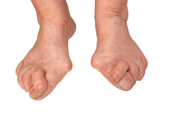 Medecin, valgus nasır, deformasyon valgus hallux (nasyon) bacağı, tedavi başarısızlığı sonucu, kırpma yolu ile beyaz arka planda izole, metin yeri