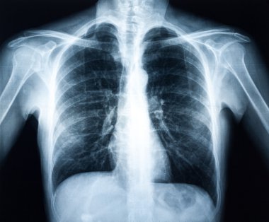 bir insan torax Xray
