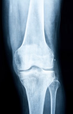 Xray of a human knee clipart