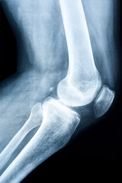 Xray van een menselijke knie — Stockfoto