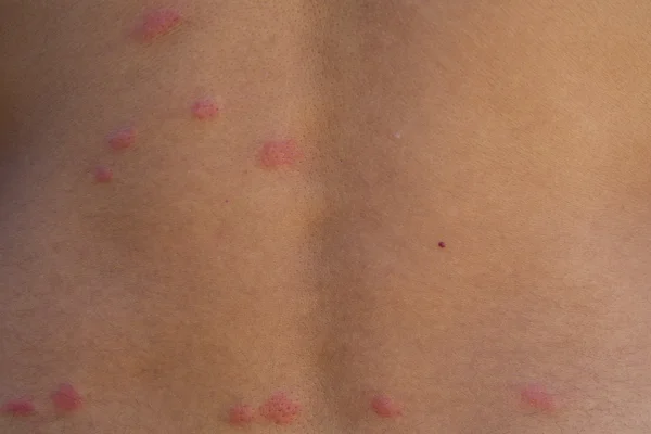 pire ısırıkları.