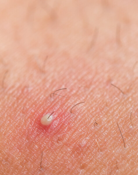 Ingrown hair
