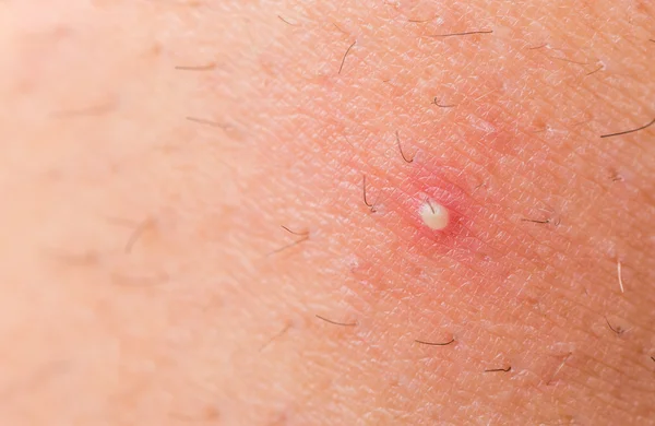 Ingrown hair closeup — Stock Photo, Image