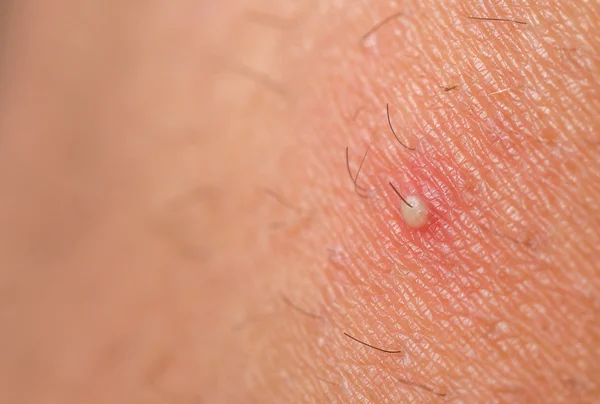 Ingrown Hair With No Head / Video Pulling Out A 6 Year Old ...