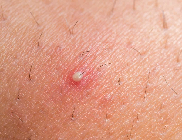 Ingrown hair — Stock Photo, Image