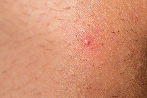 Ingrown hair