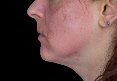 kimyasal peeling