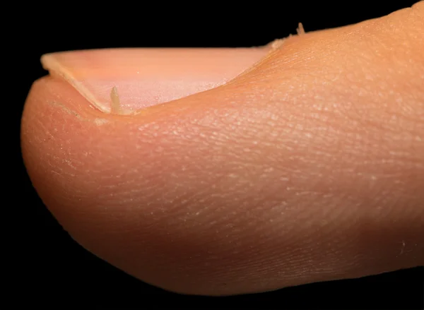 Hangnail — Stock Photo, Image