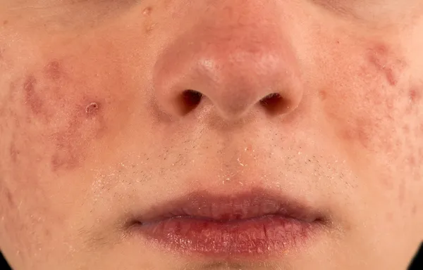 Svår acne — Stockfoto