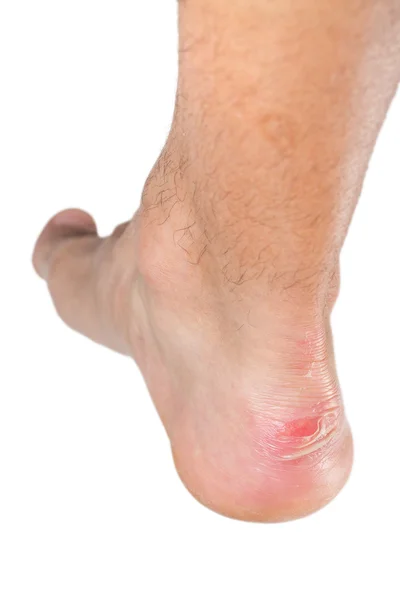 Ankle of male man with scratch — Stock Photo, Image