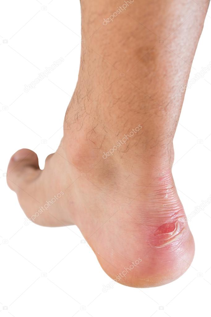 Ankle of male man with scratch