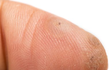 dondurulmuş sonra verruca ve blister oluşumu