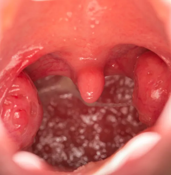 Vue bouche ouverte des amygdales Image En Vente