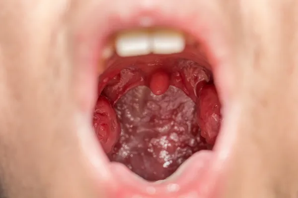 Vista da boca aberta das amígdalas — Fotografia de Stock