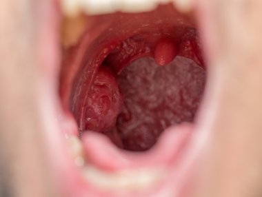 Open mouth view of tonsils clipart