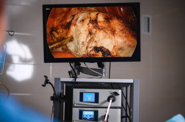 Endoskop kullanarak laparoskopik ameliyat. Modern ameliyat. Minimum invazif ameliyat