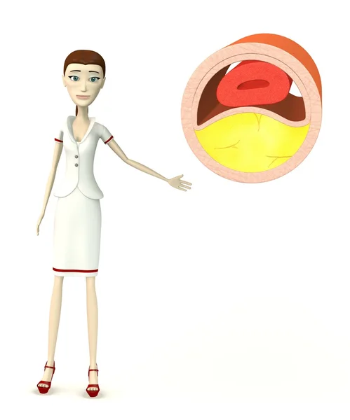 3D-Darstellung einer Zeichentrickfigur mit Vene mit Cholesterin — Stockfoto