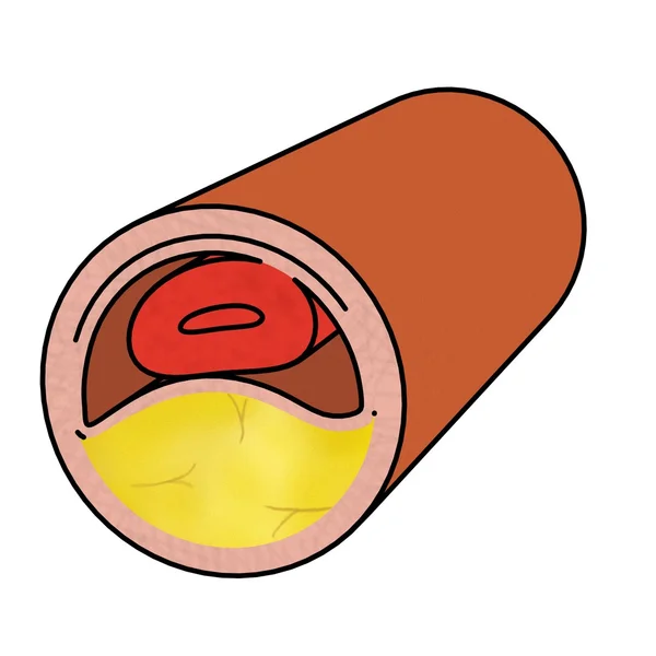 Мультяшний образ кровоносних судин з холестерином — стокове фото