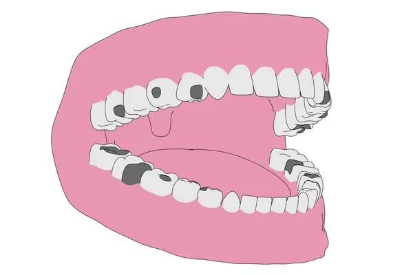 Immagine cartone animato di denti umani con otturazioni — Foto Stock