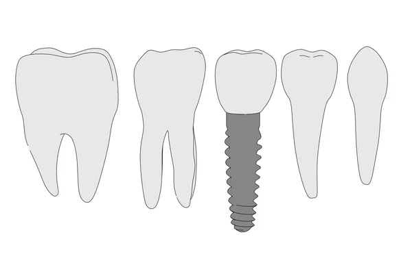 Tecknad bild av tand implantat — Stockfoto