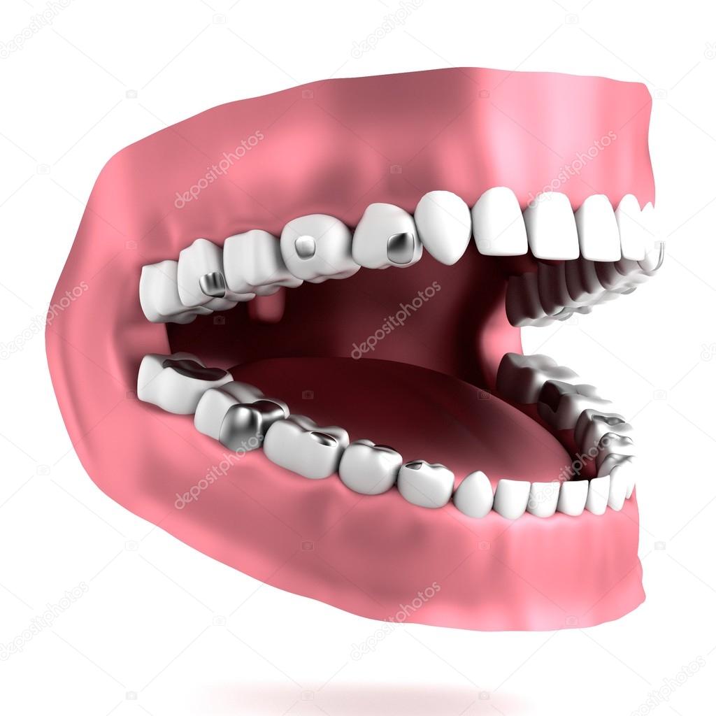 Human teeth with fillings