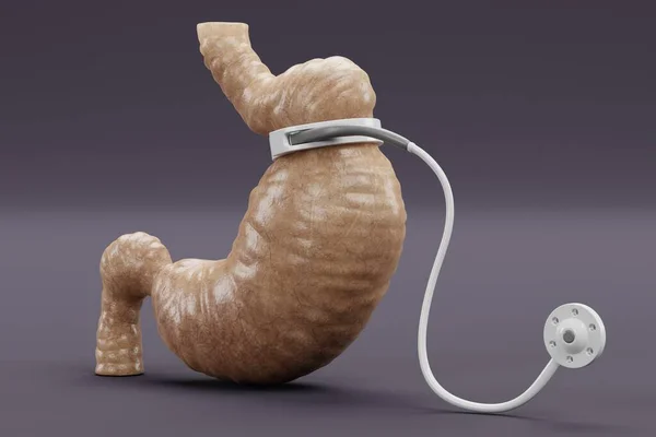胃バンドで胃の現実的な3Dレンダリング — ストック写真