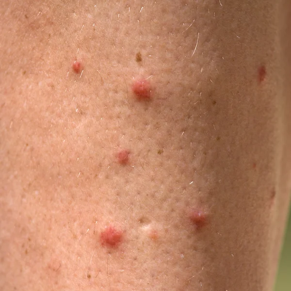 Erupção cutânea alérgica dermatite da perna pele — Fotografia de Stock