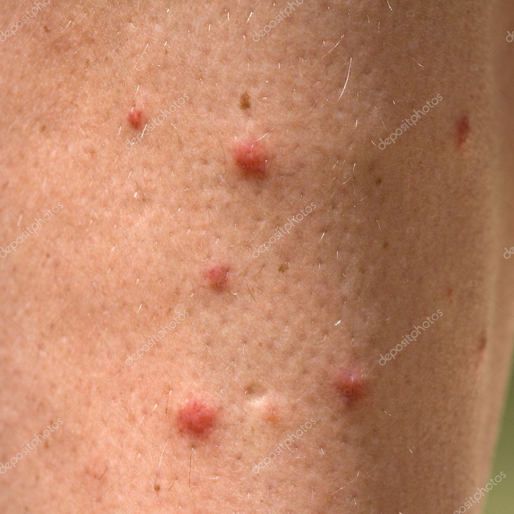 Allergic rash dermatitis leg skin Stock Photo by ©OlegDoroshenko