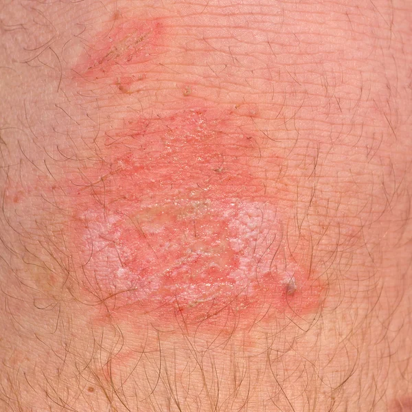 La blessure sur sa jambe — Photo