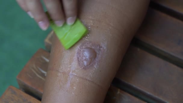 Młoda Kobieta Leczy Oparzenia Aloesu Bliskie Oparzenia Skóry Nodze Uszkodzenia — Wideo stockowe