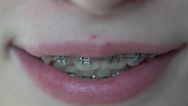 Słodka Młoda Dziewczyna Aparatem Dentystycznym Dziewczyna Nastolatek Uśmiechając Się Bliska — Wideo stockowe
