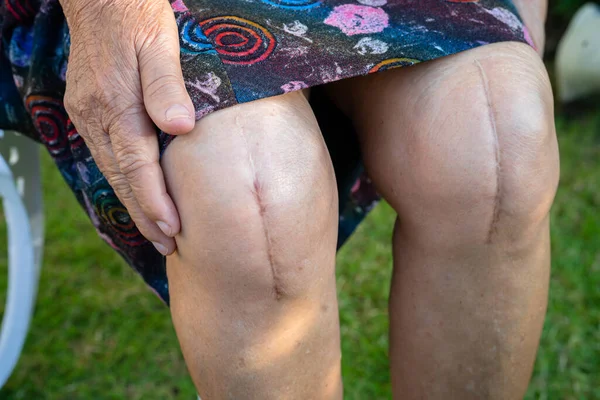 Aziatische Senior Dame Oud Vrouw Patiënt Tonen Haar Littekens Chirurgische — Stockfoto