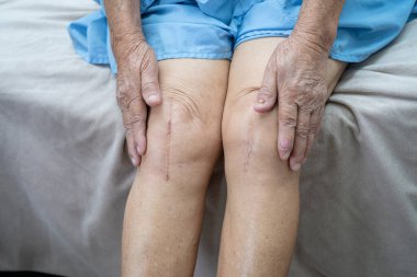 Asyalı yaşlı ya da yaşlı kadın hasta yaralarını gösteriyor. Diz eklemi ameliyatıyla değiştirilmiş. Hemşirelik hastanesi koğuşunda yatağında eklem iltihabı var..