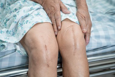 Asyalı yaşlı ya da yaşlı kadın hasta yaralarını gösteriyor. Diz eklemi ameliyatıyla değiştirilmiş. Hemşirelik hastanesi koğuşunda yatağında eklem iltihabı var..