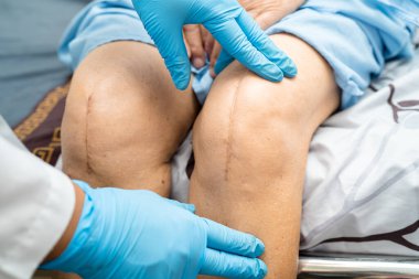 Asyalı yaşlı ya da yaşlı kadın hasta yaralarını gösteriyor. Diz eklemi ameliyatıyla değiştirilmiş. Hemşirelik hastanesi koğuşunda yatağında eklem iltihabı var..